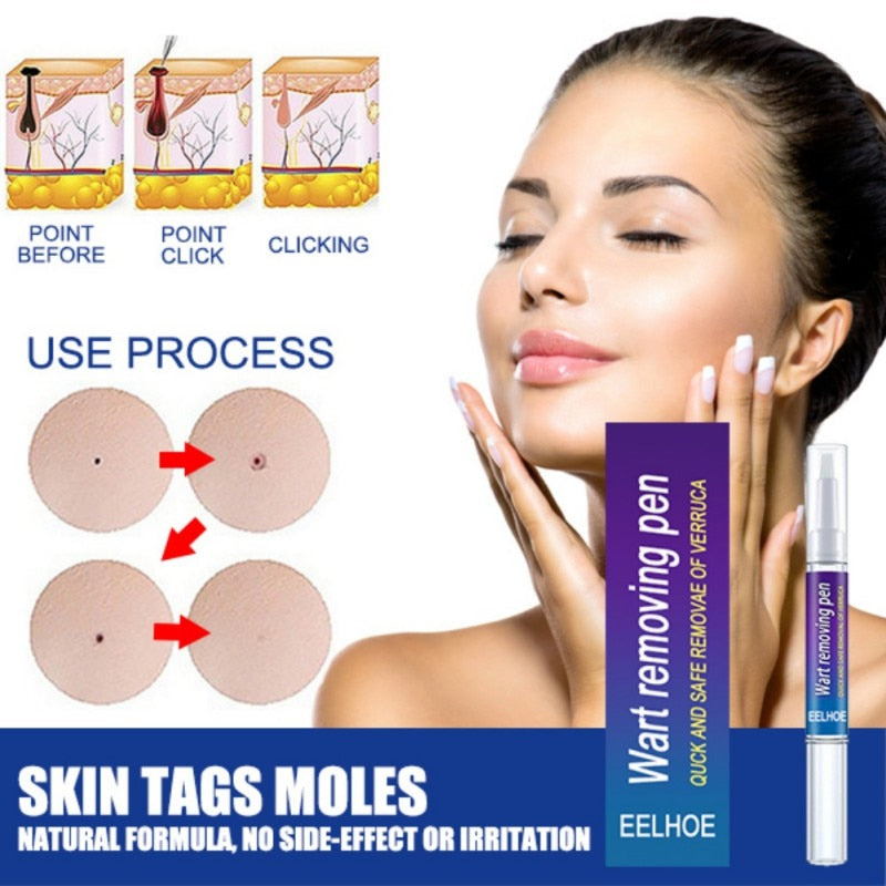 Wart Removal Mole Remedy Liquid Pen Treatment Papillomas Removing Skin Labels Flat Wart Genitals Painless Beauty Herbal Cream